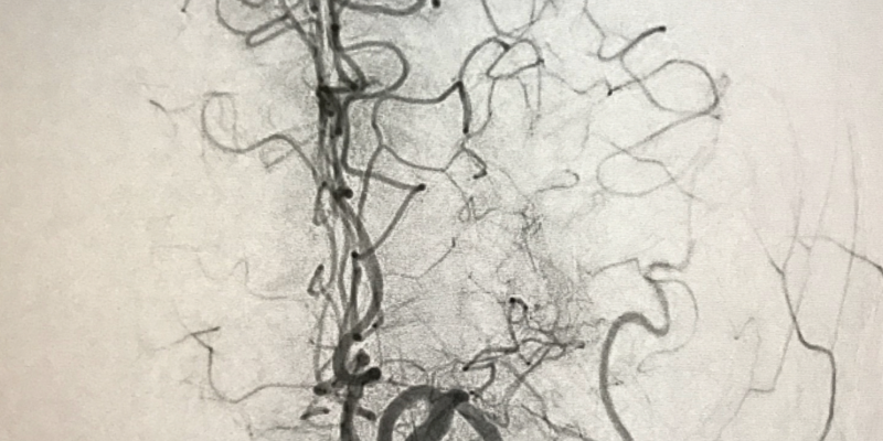 Image for Successful stroke treatment via stent retriever designed to remove thrombus in ischemic stroke